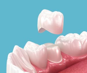 image of a dental crown
